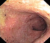 Ulcerative colitis of the sigmoid colon