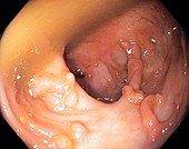 Scarred colon