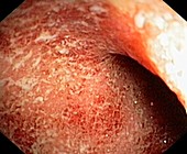 Ulcerative colitis of the rectum