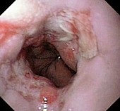 Oesophagus ulcers