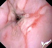 Ulcerated oesophagus