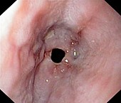 Oesophageal narrowing