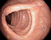 Healthy colon,large intestine