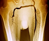 Artery bypass surgery,angiogram