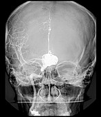 Aneurysm treatment,angiogram