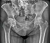Osteoarthritis of the hip,X-ray
