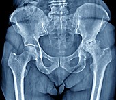 Osteoarthritis of the hip,X-ray