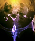 Female reproductive system,X-ray