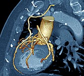 Heart bypass,3D CT scan