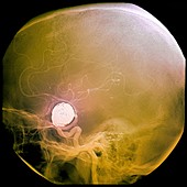 Aneurysm treatment,angiogram