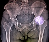 Osteoarthritis of the hip,X-ray