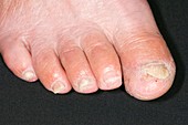 Fungal nail infection