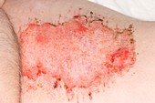 Skin graft donor site