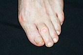 Bunion and hammer toe