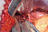 Gall bladder cancer surgery