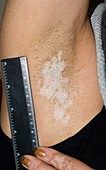 Vitiligo of the underarm