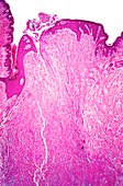 Pilonidal sinus,light micrograph