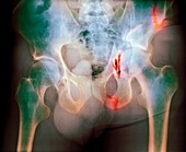 Fractured pelvis,X-ray