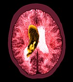 Brain haemorrhage,CT scan