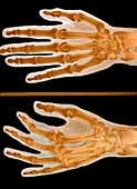 Thumb injury,X-ray