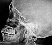 Facial sinuses,X-ray