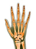 Child's hand,X-ray