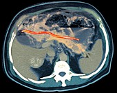 Ectopic pancreatic stent,CT scan