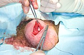 Scrotum surgery