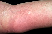 Allergic rash