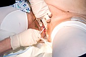 Inserting a urinary catheter