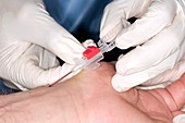 Inserting a cannula
