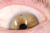 Foreign body in eye
