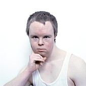 Face of a man with Down's syndrome