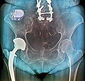 X-ray of implant for incontinence