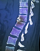 Pinched vertebral disc of spine