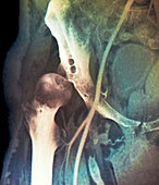 Dislocation of hip in coxa magna