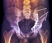 'Pinned hip fractures,X-ray'