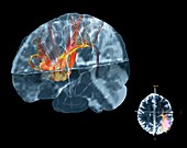 Brain cancer affecting nerve fibres