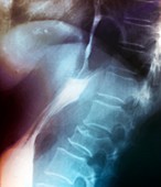 Swallow reflux test for hiatus hernia