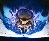 'Herniated spinal disc,MRI scan'