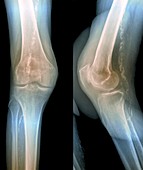 'Osteoarthritis of knee cap,X-ray'
