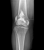 Treatment of knee osteoarthritis