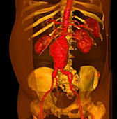 Aortic aneurysm,3-D CT scan