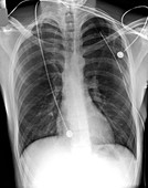 'Pneumothorax treatment,X-ray'