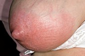 Inflamed breast with mastitis