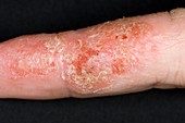 Eczema on the finger