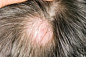 Sebaceous cyst on the scalp