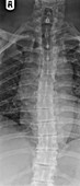 'Scoliosis of the spine,X-ray'
