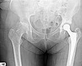 Hip joint replacement (image 2 of 2)