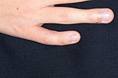 Angulation in finger after fracture